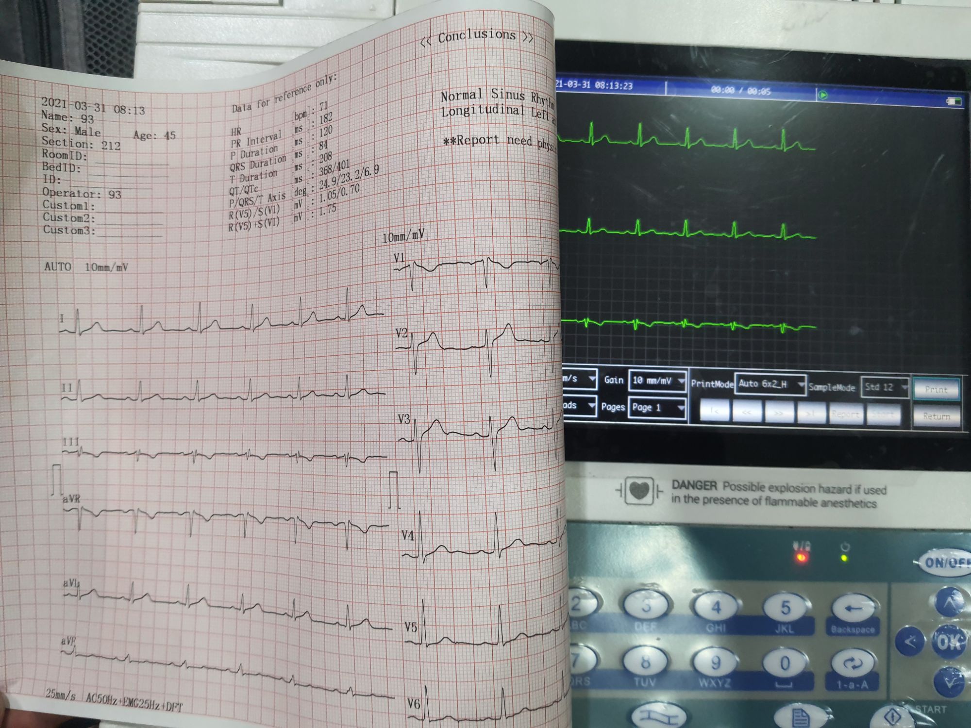กระดาษปริ้นท์ EKG/ECG ขนาด 210mm. x 25เมตร (1 แพ็ค มี 2 ม้วน) Stock สินค้าอยู่ในประเทศไทย