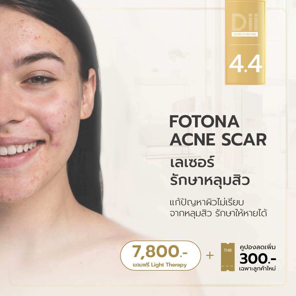 [E-Voucher] Dii Aesthetic : Fotona Acne Scar (เลเซอร์รักษาหลุมสิว) ราคา 15,000 บาท*ส่งฟรี