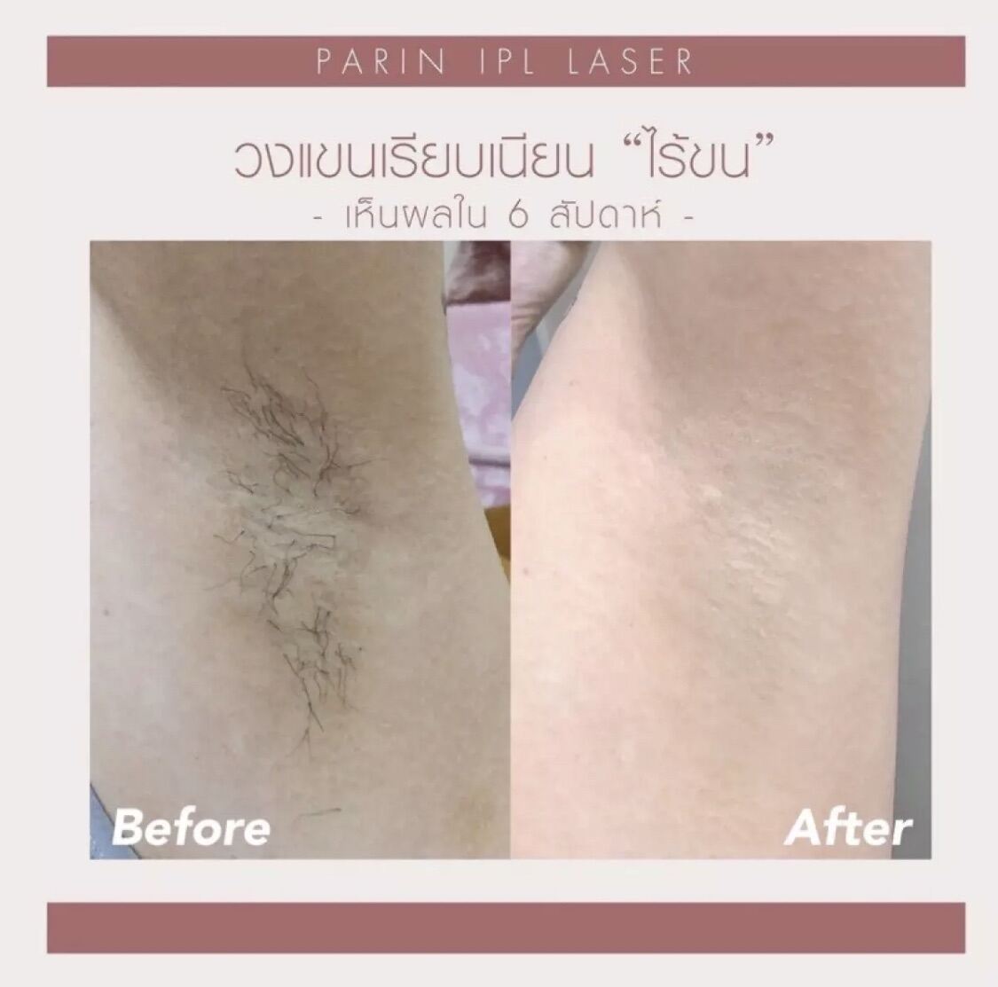 Underarm Exclusive Set ( 3 pcs) UP IN ARM X PARIN IPL LASER Erb