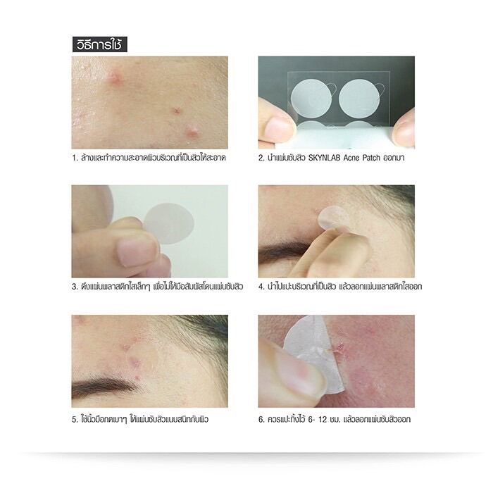 แผ่นแปะดูดสิว สกินแล็บ แอคเน่ แพทช์ (1แผ่น มี10ชิ้น) SKYNLAB ACNE PATCH. 