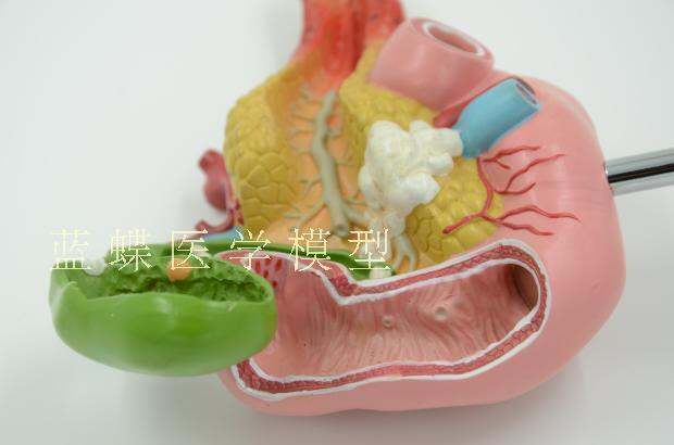 ทางการแพทย์ตับอ่อน十二指肠ถุงน้ำดีพยาธิวิทยาแบบจำลองนิ่วในถุงน้ำดีแผนกศัลยกรรมย่อยระบบแบบจำลอง
